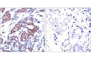 Immunohistochemistry analysis of paraffin-embedded human breast carcinoma, using Elk1 (Phospho-Ser383) Antibody. (ELK1 Antikörper  (AA 351-400))