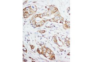 Anti-IGF1 antibody, IHC(P) IHC(P): Human Mammary Cancer Tissue (IGF1 Antikörper  (Middle Region))