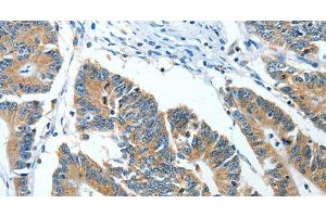 Immunohistochemistry of paraffin-embedded Human colon cancer tissue using ANGPT1 Polyclonal Antibody at dilution 1:50 (Angiopoietin 1 Antikörper)