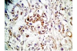 Human stomach cancer tissue was stained by rabbit anti-Spexin(H) Antiserum (Spexin Antikörper)