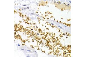 Immunohistochemistry of paraffin-embedded human stomach cancer using OPRL1 antibody at dilution of 1:200 (400x lens). (OPRL1 Antikörper)