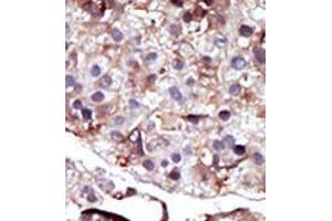 Formalin-fixed and paraffin-embedded human cancer tissue (hepatocarcinoma) reacted with the primary antibody, which was peroxidase-conjugated to the secondary antibody, followed by AEC staining. (SPHK2 Antikörper  (N-Term))