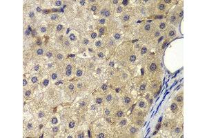 Immunohistochemistry of paraffin-embedded Human liver cancer using AP2A2 Polyclonal Antibody at dilution of 1:200 (40x lens). (AP2A2 Antikörper)