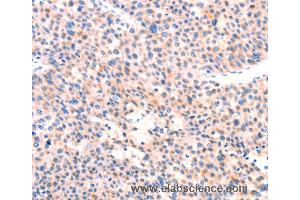 Immunohistochemistry of Human thyroid cancer using APBA2 Polyclonal Antibody at dilution of 1:80