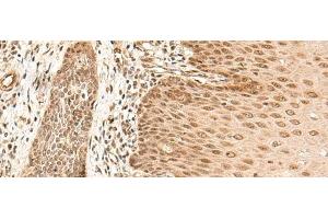 Immunohistochemistry of paraffin-embedded Human esophagus cancer tissue using ARMC8 Polyclonal Antibody at dilution of 1:40(x200) (ARMC8 Antikörper)