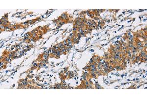 Immunohistochemistry of paraffin-embedded Human gastic cancer using PIP4K2A Polyclonal Antibody at dilution of 1:40 (PIP4K2A Antikörper)