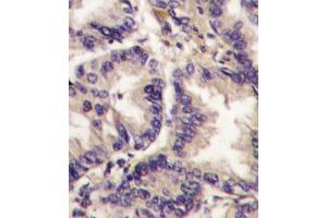 Formalin-fixed and paraffin-embedded human lung carcinoma tissue reacted with , which was peroxidase-conjugated to the secondary antibody, followed by DAB staining. (VEGFC Antikörper  (AA 248-277))