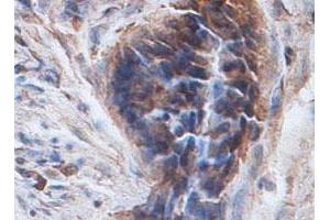 Immunohistochemical staining of formalin-fixed paraffin-embedded human colon carcinoma tissue showing cytoplasmic staining with PTPN12 polyclonal antibody  at 1 : 100 dilution. (PTPN12 Antikörper  (AA 544-771))