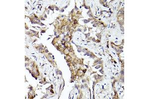 Immunohistochemistry of paraffin-embedded human lung cancer using Axl Rabbit pAb (ABIN7265804) at dilution of 1:100 (40x lens).
