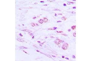 Immunohistochemical analysis of BAIAP2L1 staining in human lung cancer formalin fixed paraffin embedded tissue section.