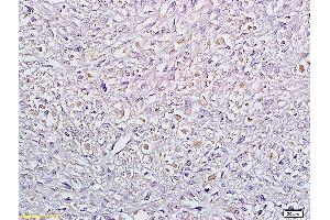 Formalin-fixed and paraffin embedded human cervical carcinoma labeled with Anti Sertad1 Polyclonal Antibody, Unconjugated (ABIN720011) at 1:200 followed by conjugation to the secondary antibody and DAB staining