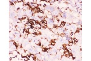 IHC-P: LFA-1 antibody testing of human lung cancer tissue (ITGAL Antikörper  (AA 404-769))