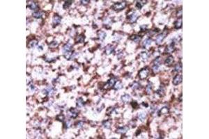 IHC analysis of FFPE human hepatocarcinoma stained with the BACE2C antibody (BACE2C Antikörper  (AA 310-339))
