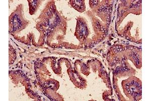 Immunohistochemistry of paraffin-embedded human prostate cancer using ABIN7149190 at dilution of 1:100 (Cytochrome C1 Antikörper  (AA 85-325))