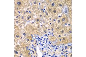 Immunohistochemistry of paraffin-embedded human liver injury using CARD11 antibody (ABIN5974295) at dilution of 1/100 (40x lens). (CARD11 Antikörper)