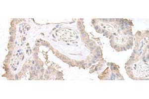 Immunohistochemistry of paraffin-embedded Human thyroid cancer tissue using STAU2 Polyclonal Antibody at dilution of 1:45(x200) (Double-stranded RNA-binding protein Staufen homolog 2 (STAU2) Antikörper)