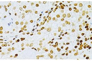 Immunohistochemistry of paraffin-embedded Human cancer using DKC1 Polyclonal Antibody at dilution of 1:200 (40x lens). (DKC1 Antikörper)