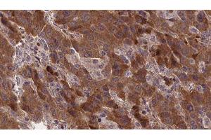 ABIN6277371 at 1/100 staining Human liver cancer tissue by IHC-P. (GRPR Antikörper  (Internal Region))