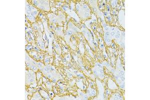 Immunohistochemistry of paraffin-embedded human liver cancer using TGFBI antibody (ABIN5971386) at dilution of 1/100 (40x lens). (TGFBI Antikörper)