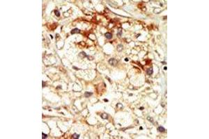 Formalin-fixed and paraffin-embedded human cancer tissue reacted with the primary antibody, which was peroxidase-conjugated to the secondary antibody, followed by DAB staining. (CDK17 Antikörper  (N-Term))