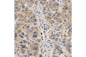 Immunohistochemistry of paraffin-embedded human liver cancer using VAPB Antibody (ABIN5973099) at dilution of 1/200 (40x lens).