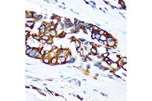 Immunohistochemistry of paraffin-embedded human lung cancer using KRT36 Rabbit pAb (ABIN6130229, ABIN6143029, ABIN6143030 and ABIN6217868) at dilution of 1:100 (40x lens). (Keratin 36 Antikörper  (AA 388-467))