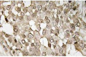 Immunohistochemistry (IHC) analyzes of p-NFkappaB-p65 antibody in paraffin-embedded human breast carcinoma tissue. (NF-kB p65 Antikörper  (pSer529))