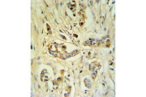 FIBB Antibody (C-term) (ABIN390414 and ABIN2840803) IHC analysis in formalin fixed and paraffin embedded human breast carcinoma followed by peroxidase conjugation of the secondary antibody and DAB staining. (Fibrinogen beta Chain Antikörper  (C-Term))