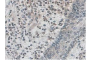 IHC-P analysis of Human Skin Cancer Tissue, with DAB staining. (PALLD Antikörper  (AA 1137-1383))