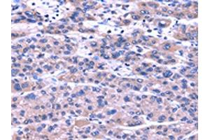 The image on the left is immunohistochemistry of paraffin-embedded Human liver cancer tissue using ABIN7131486(TRIM49 Antibody) at dilution 1/40, on the right is treated with fusion protein. (TRIM49 Antikörper)