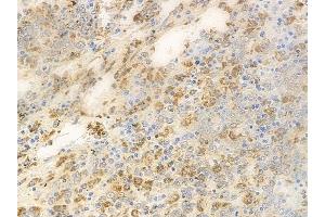 ABIN6264241 and ABIN6269167 at 1/100 staining human melanoma by IHC-P.