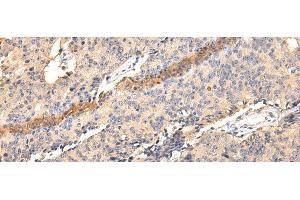 Immunohistochemistry of paraffin-embedded Human prostate cancer using SDCBP Polyclonal Antibody at dilution of 1/40 (SDCBP Antikörper)