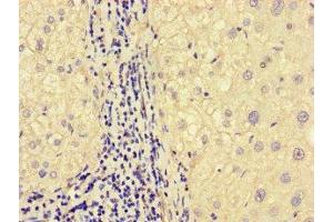 Immunohistochemistry of paraffin-embedded human liver cancer using ABIN7160331 at dilution of 1:100 (FAT Atypical Cadherin 2 (FAT2) (AA 123-314) Antikörper)