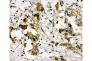 Anti-COMT antibody, IHC(P) IHC(P): Human Lung Cancer Tissue