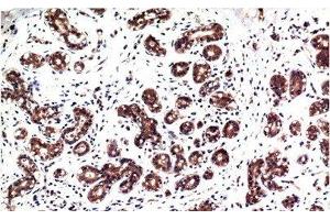 Immunohistochemistry of paraffin-embedded Human breast carcinoma tissue with Phospho-ERK 1/2 (Tyr222/205) Monoclonal Antibody at dilution of 1:200 (ERK1/2 Antikörper  (pTyr205, pTyr222))