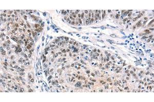 Immunohistochemistry of paraffin-embedded Human ovarian cancer using CTBP2 Polyclonal Antibody at dilution of 1:40 (CTBP2 Antikörper)