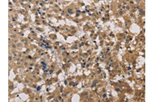The image on the left is immunohistochemistry of paraffin-embedded Human thyroid cancer tissue using ABIN7129190(DEGS1 Antibody) at dilution 1/40, on the right is treated with fusion protein. (DEGS1 Antikörper)