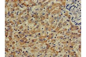 Immunohistochemistry of paraffin-embedded human liver cancer using ABIN7148969 at dilution of 1:100 (CTH Antikörper  (AA 1-70))