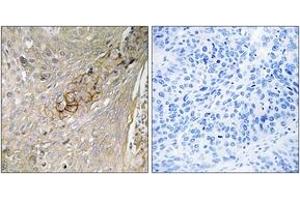 Immunohistochemistry analysis of paraffin-embedded human lung carcinoma tissue, using SLC6A6 Antibody. (TAUT Antikörper  (AA 561-610))