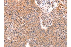The image on the left is immunohistochemistry of paraffin-embedded Human liver cancer tissue using ABIN7129152(DAZ4 Antibody) at dilution 1/50, on the right is treated with fusion protein. (DAZ4 Antikörper)