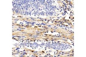 Immunohistochemistry analysis of paraffin-embedded human colon cancer using MFAP4 (ABIN7074614) at dilution of 1: 2000 (MFAP4 Antikörper)