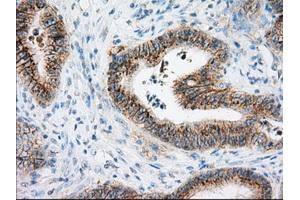 Immunohistochemical staining of paraffin-embedded Adenocarcinoma of colon tissue using anti-BSG mouse monoclonal antibody. (CD147 Antikörper)