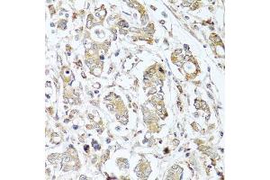 Immunohistochemistry of paraffin-embedded human gastric cancer using CPA1 antibody. (CPA1 Antikörper)