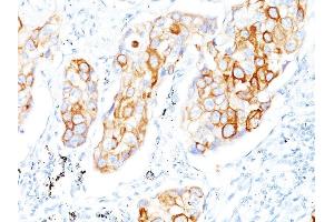 Formalin-fixed, paraffin-embedded human Lung SCC stained with Cytokeratin 7/17 Mouse Monoclonal Antibody (C-46). (Keratin 7/17 Antikörper)