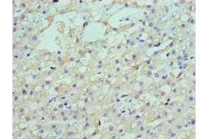 Immunohistochemistry of paraffin-embedded human liver cancer using ABIN7158555 at dilution of 1:100 (LDLRAP1 Antikörper  (AA 59-308))