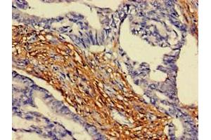 Immunohistochemistry of paraffin-embedded human colon cancer using ABIN7144568 at dilution of 1:100 (ARAP3 Antikörper  (AA 163-320))