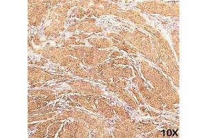 IHC staining of human leiomyosarcoma (10X) with Muscle actin antibody (HHF35).