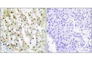 Immunohistochemistry analysis of paraffin-embedded human liver carcinoma tissue, using hnRNP A1 Antibody. (HNRNPA1 Antikörper  (AA 51-100))