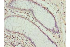 Immunohistochemistry of paraffin-embedded human colon cancer using ABIN7148653 at dilution of 1:100 (CPXCR1 Antikörper  (AA 1-301))