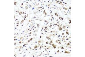 Immunohistochemistry of paraffin-embedded human gastric cancer using HIRA antibody. (HIRA Antikörper  (AA 250-550))